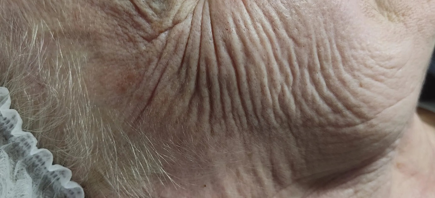 Terapia Healthy Aging – przed